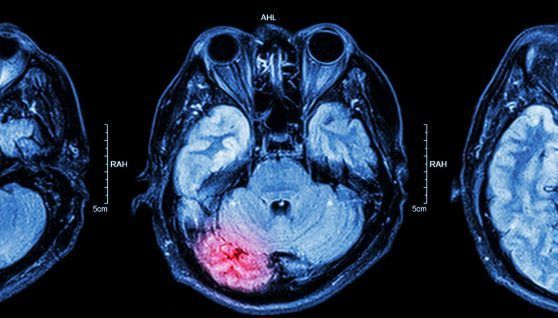 A gen linked to radio sensitivity could help to improve radiotherapy treatment
