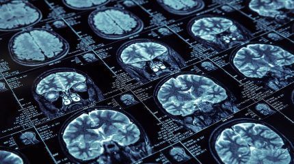 Alzheimer’s disease: Patients benefit from nuclear imaging